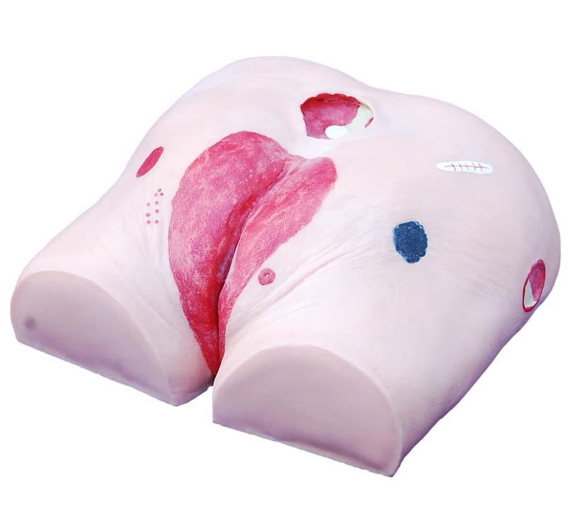XC-459 Decubitus Ulcer Care Model